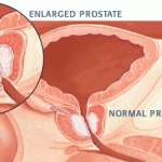 prostate bph