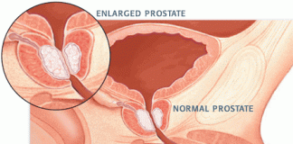 prostate bph